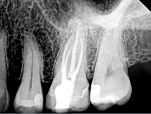 Completed Root Canal Treatment of the same tooth—all 4 canals treated