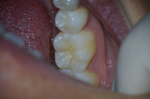 Endodontic Operating Microscope at 8.0X magnification