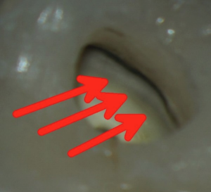 Internal staining underneath a crown