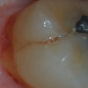 Detailed microfracture anatomy