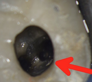 3 Root canals located in a single root