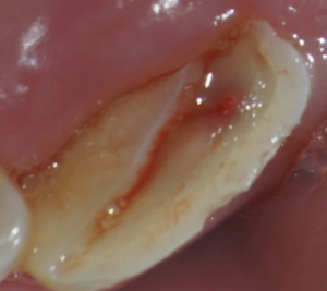 Pulp exposure due to a fracture of a front tooth