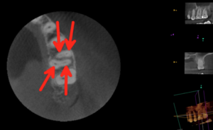 3D Cone Beam CT image of the same tooth clearly showing 4 canals